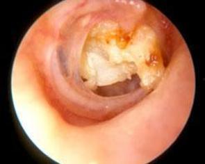 胆脂瘤图片,胆脂瘤影像学特征解析与临床诊断要点