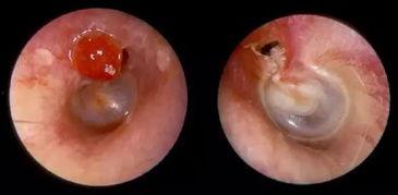 胆脂瘤图片,胆脂瘤影像学特征解析与临床诊断要点