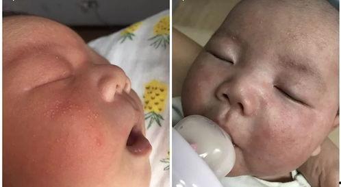 过敏湿疹图片,揭秘常见湿疹类型及特征