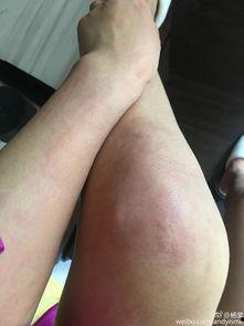 过敏湿疹图片,揭秘常见湿疹类型及特征