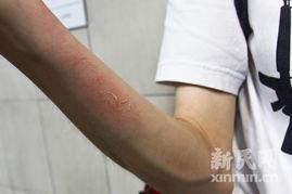 胳膊破了图片大全,常见胳膊伤口处理技巧解析