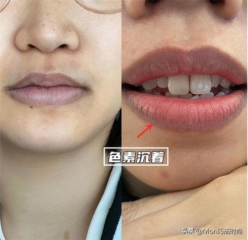 嘴唇色素沉着图片