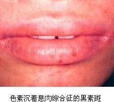嘴唇色素沉着图片