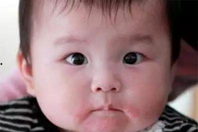 湿疹婴儿图片大全,图片解析常见症状及应对方法