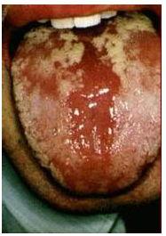 鹅口疮是什么样的图片