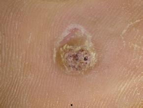 跖疣图片大全,全面了解跖疣特征与防治方法