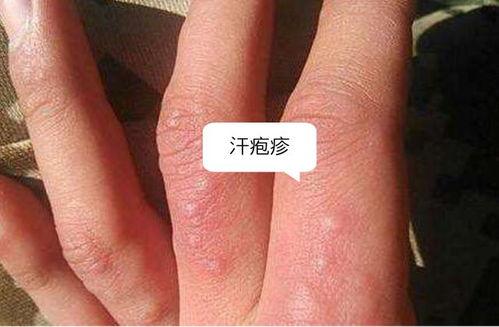 汗疱疹的图片,图片解析下的症状与成因