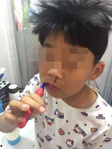 鼻血图片,揭秘鼻出血的成因与应对策略